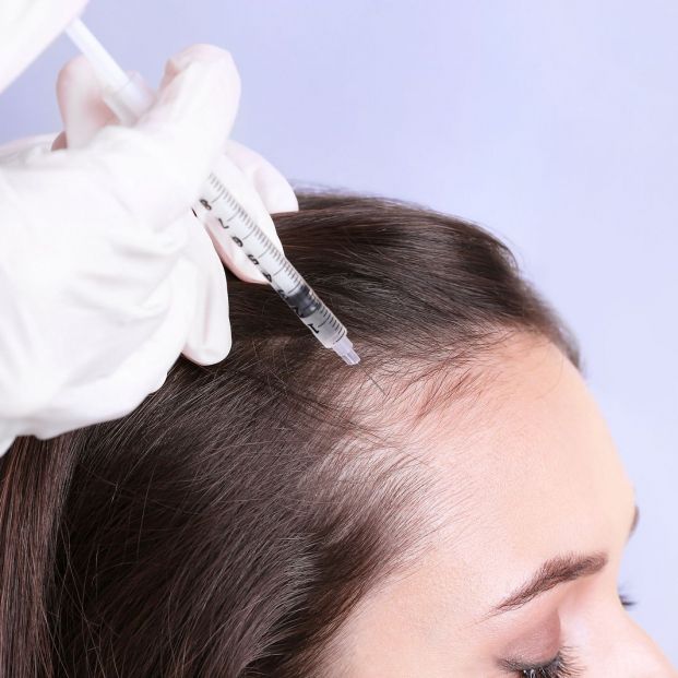 Aplicación del plasma en plaquetas para el pelo